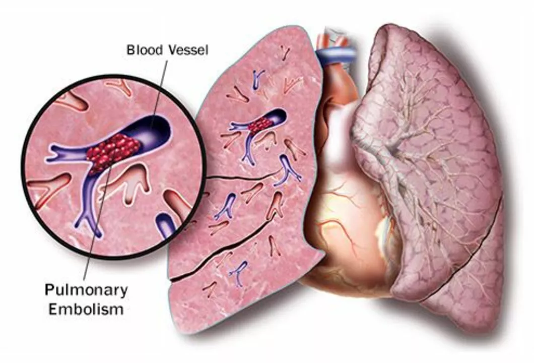 The Psychological Impact of Pulmonary Embolism: Coping with Anxiety and Fear