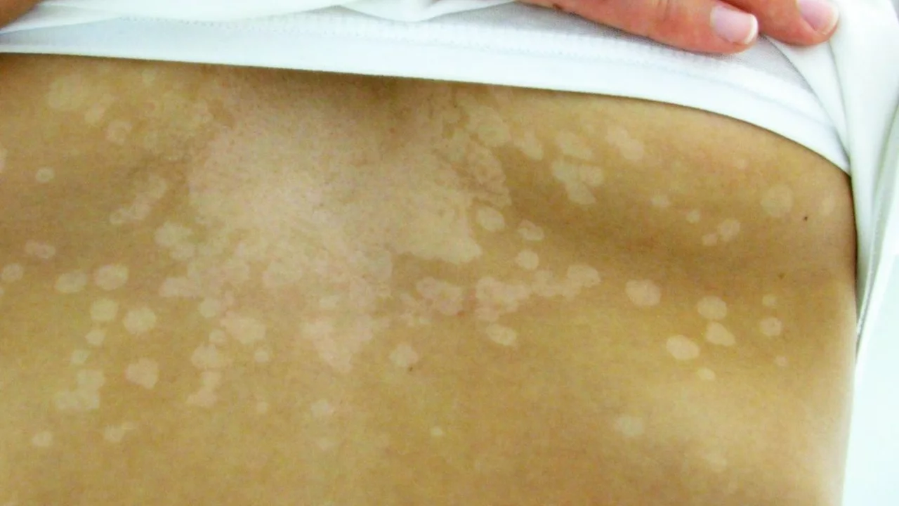 How to identify a fungus that discolors the skin