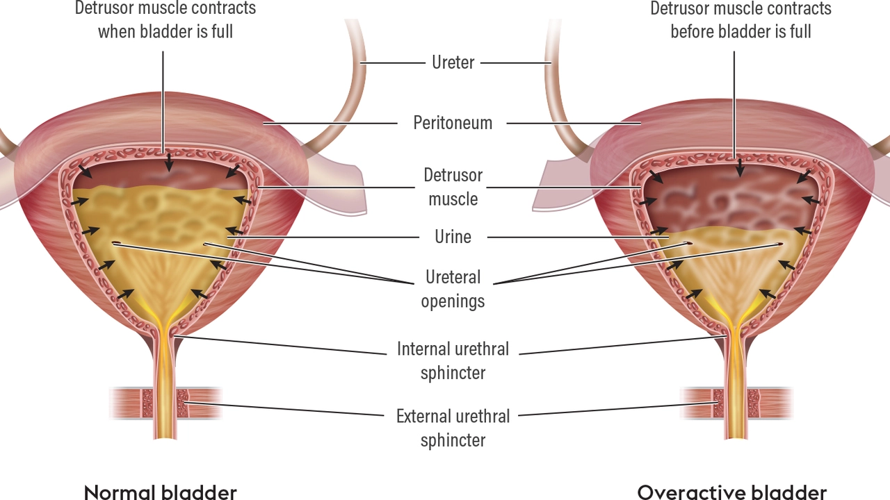 How to Manage Bladder Spasms Naturally: Tips and Tricks