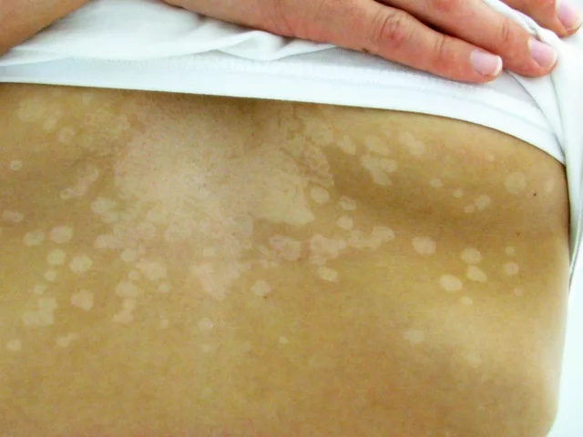 How to identify a fungus that discolors the skin